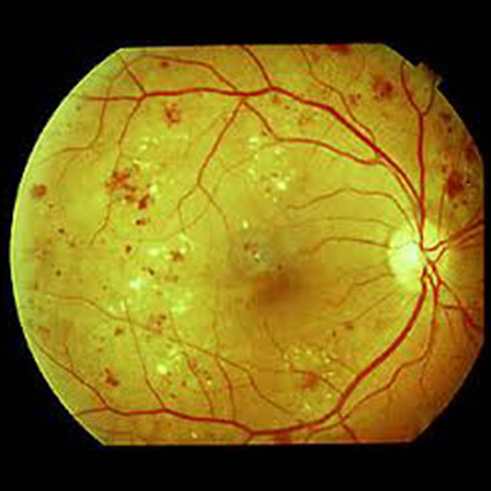 Retina Check Up in India
